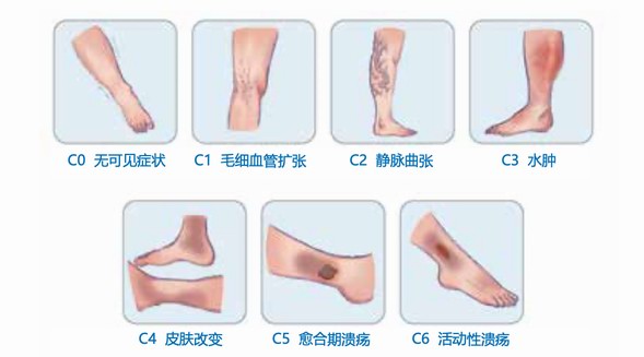 互联网洞察助力规范诊疗，让1.2亿患者夏天不惧“蚯蚓腿”